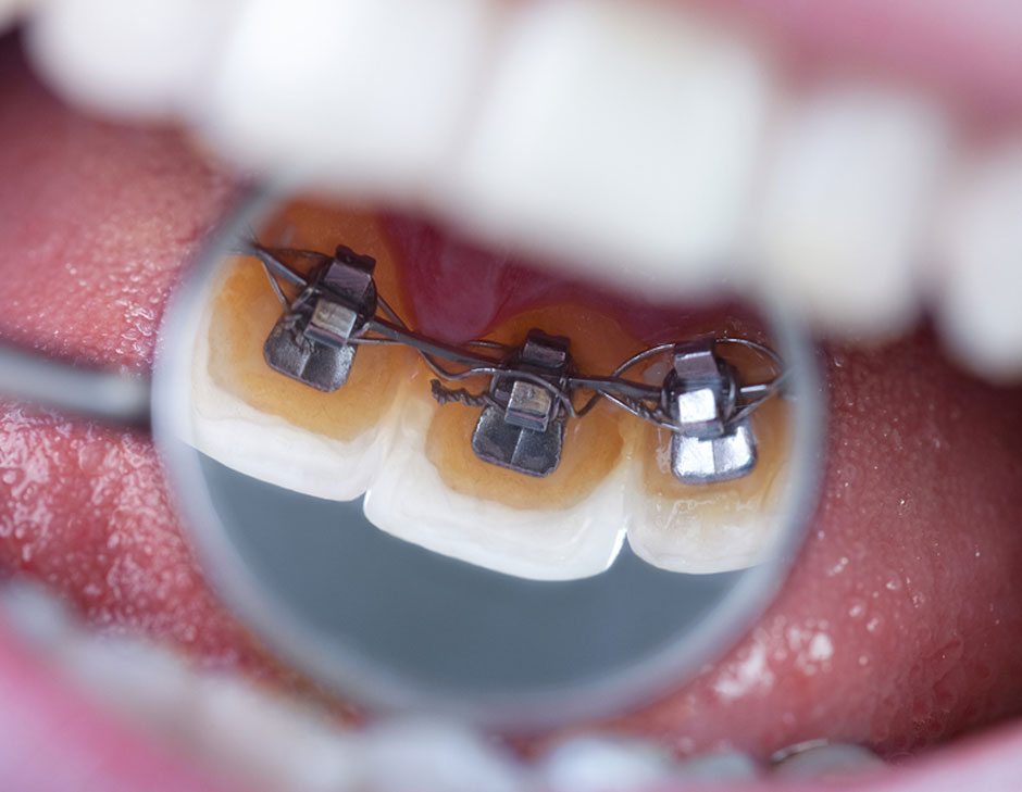 Lingual-treatment-01.jpg