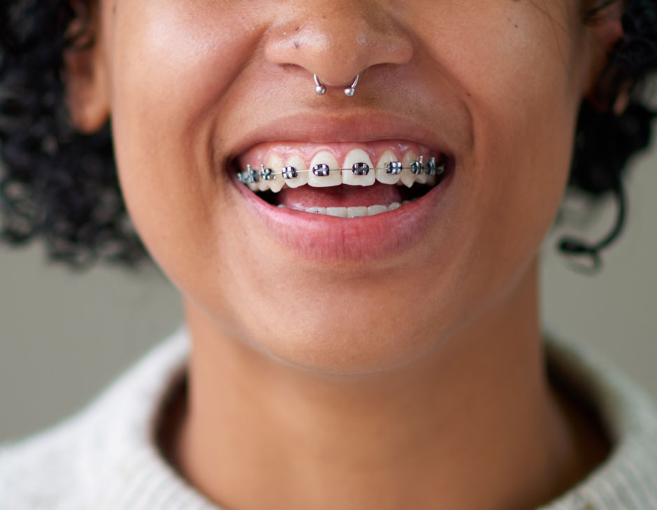 Fixed-Braces-01.jpg