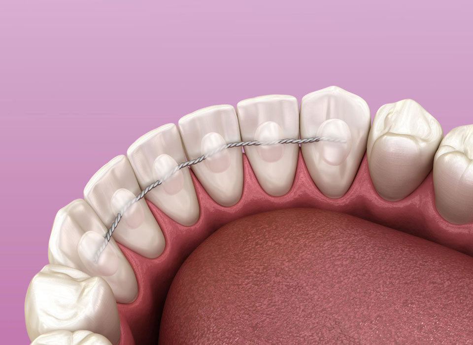 Types of Retainers We Offer in Cheshire