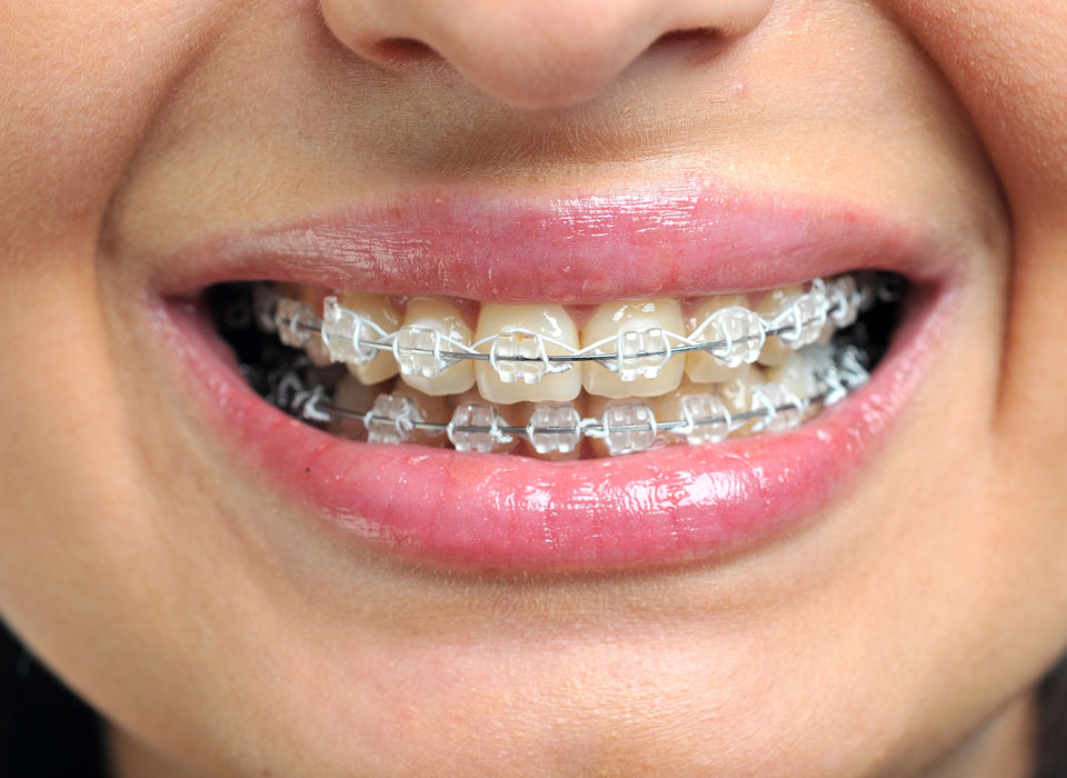 Why Choose Ceramic Braces in Cheshire?
