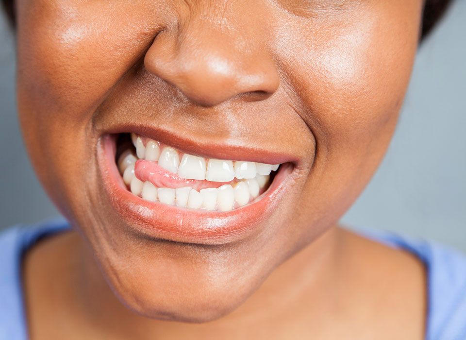 Lingual Braces vs Invisalign®– Which Is More Discreet?