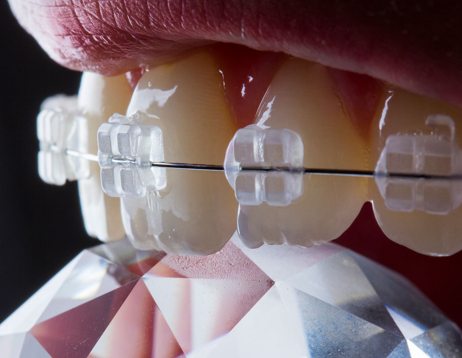 Ceramic-Braces-01.jpg