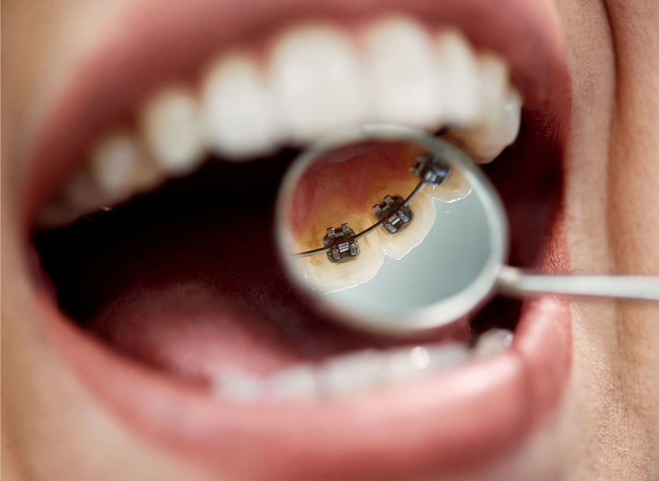 Book Your Lingual Braces Consultation in Cheshire