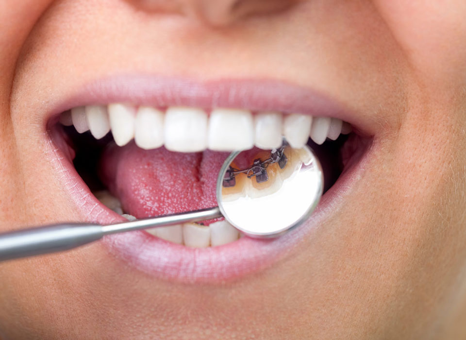 Why Choose Lingual Braces in Cheshire?
