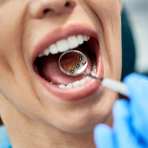 Lingual Braces in Cheshire