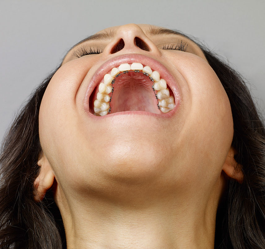 What Are Lingual Braces?