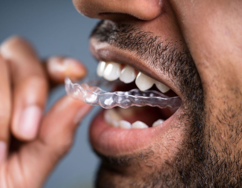 Retainer-treatment-01.jpg